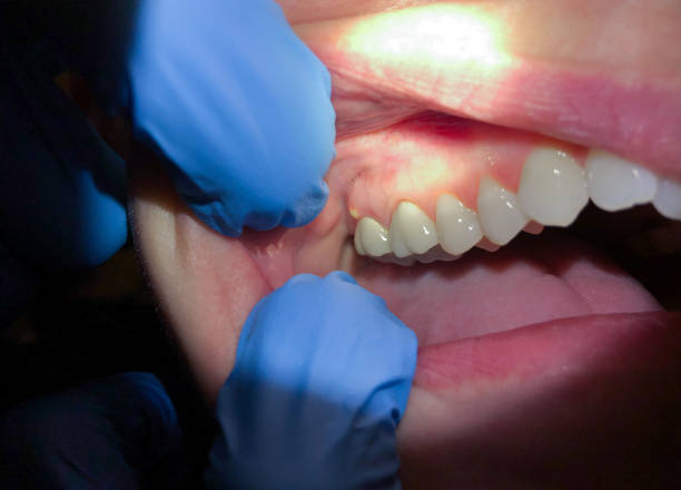 Best Emergency Dental Extractions in Rio Grande, OH